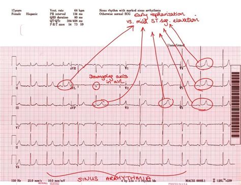 minimal high lateral repolarization disturbance.